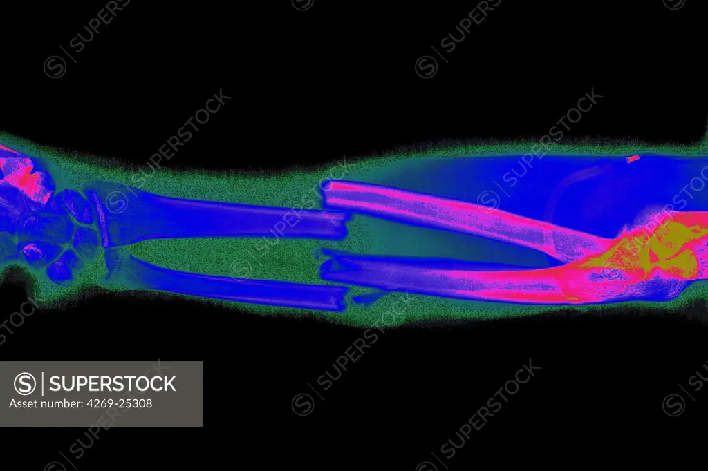 Forarm fracture. Colored X-ray of a compound fracture of the radius (upper bone) and ulna (lower bone) forearm bones.