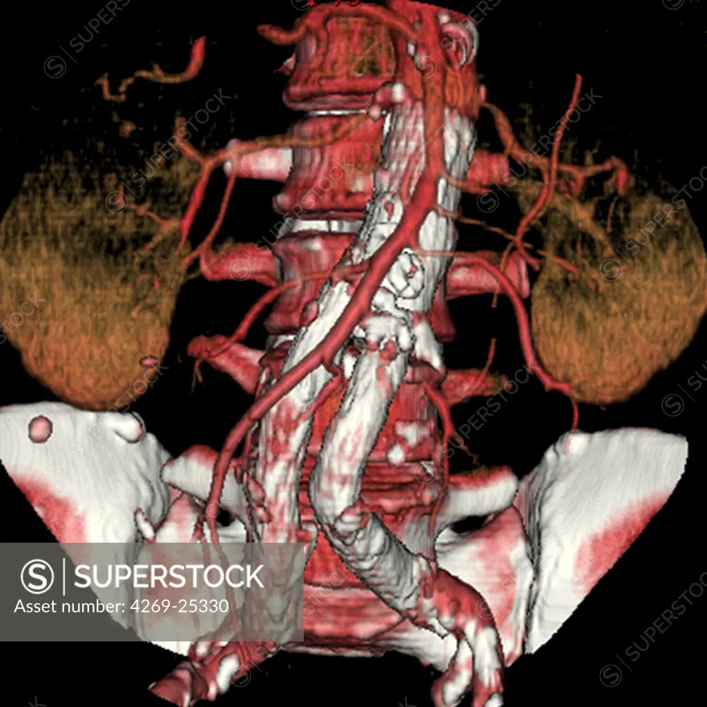 Angioplasty. 3D computed tomographic (CT) scan reconstruction of a stenosis of the abdominal aorta and common iliac arteries treated by placing a stent.