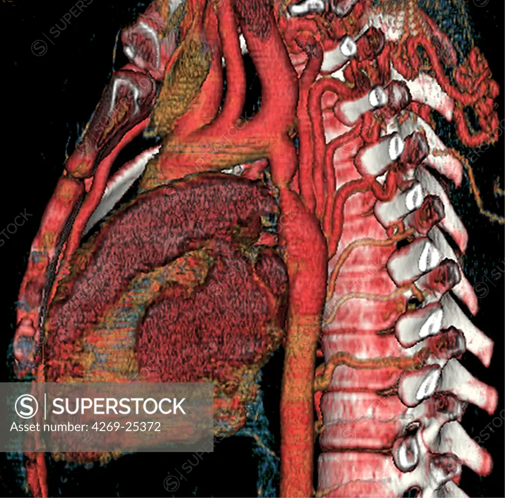 Coarctation of the aorta. 3D computed tomographic (CT) scan reconstruction showing a coarctation of the aorta. It is a malformation of the aorta, often congenital, resulting in a narrowing of the aorta seen here just below the aortic arch.