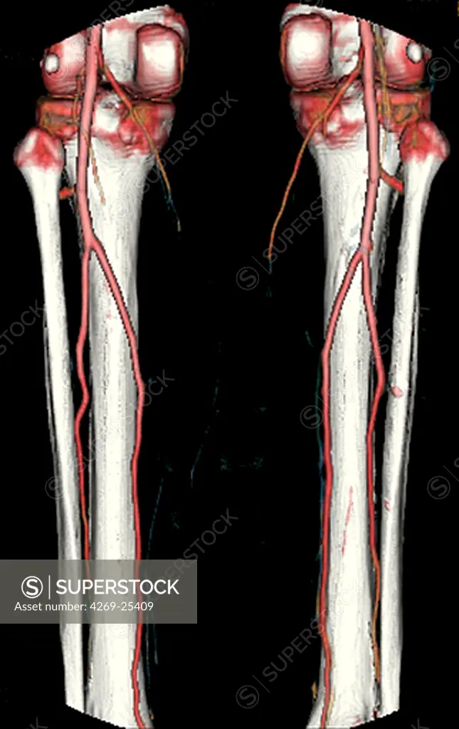 Lower leg bones and arteries. 3D computed tomographic (CT) scan reconstruction of the lower part of the leg showing the bones of the knee, fibula and tibia, as well as the popliteal and tibial arteries.