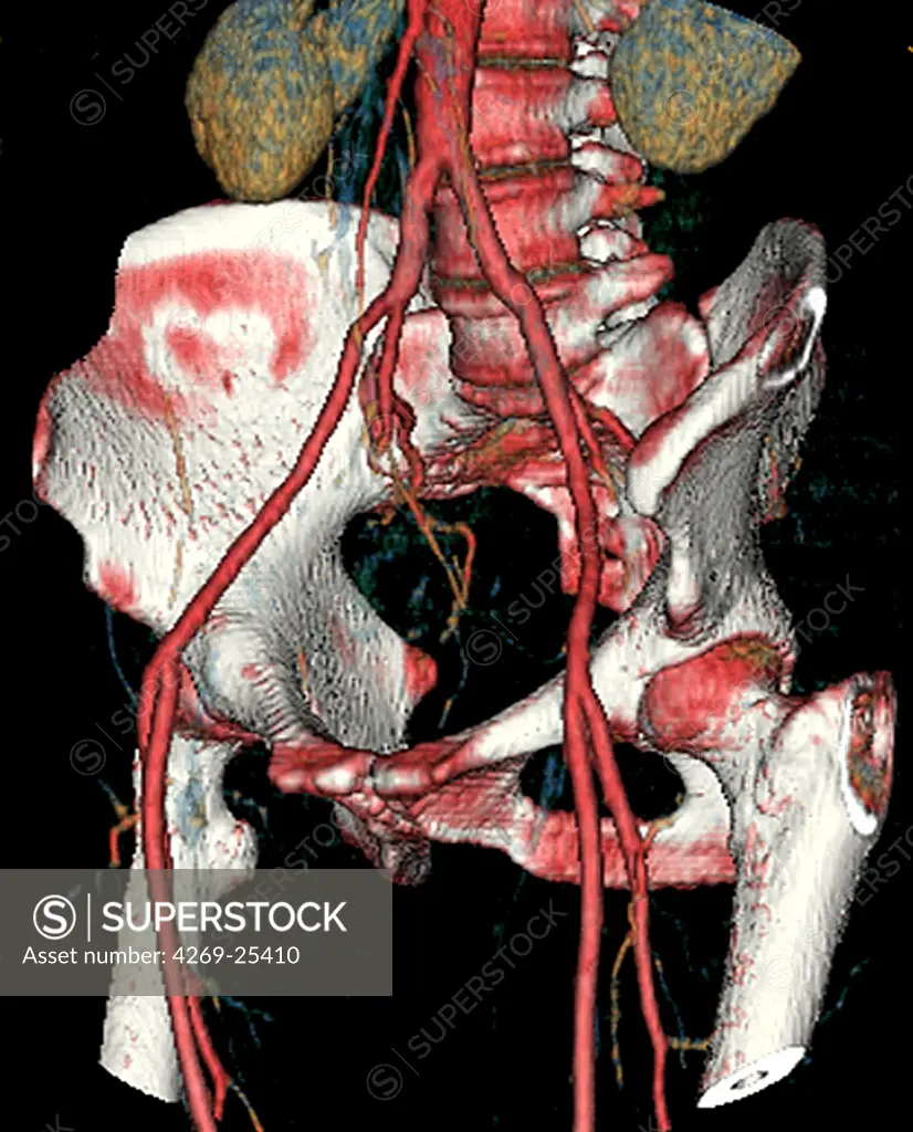 Iliac arteries. 3D computed tomographic (CT) scan reconstruction of the pelvis. At top, the abdominal aorta divides into the 2 iliac common arteries, dividing into femoral arteries on the groin. Are also seen the femurs that articulate in the coxxys, the lower rachis and the kidneys (at top, brown).