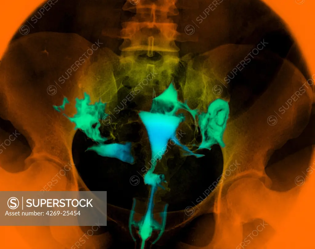 Hysterography. X-ray of female reproductive organs. A contrast medium was introduced into the uterus (center) and its Fallopian tubes (oviducts, thin, extending from uterus) through the uterine neck.