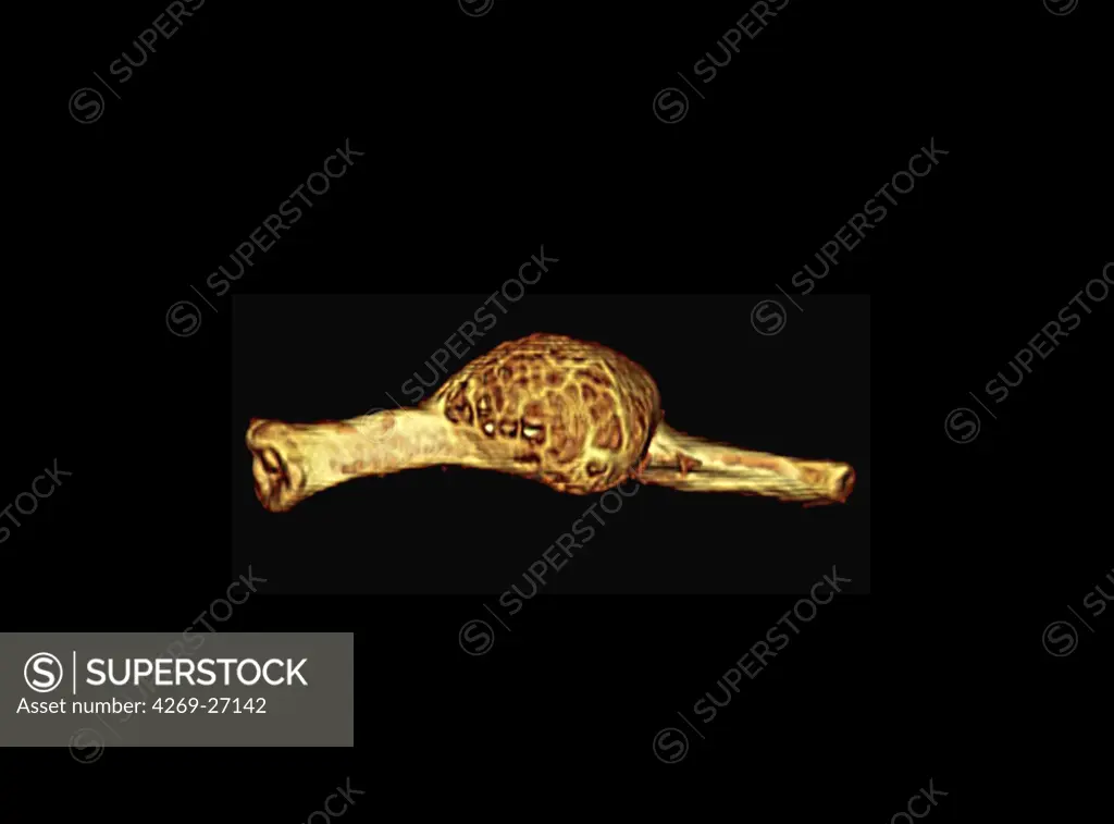 Bone cyst. Color enhanced axial 3D computed tomography (CT) scan of the the left clavicle with aneurysmal bone cyst.