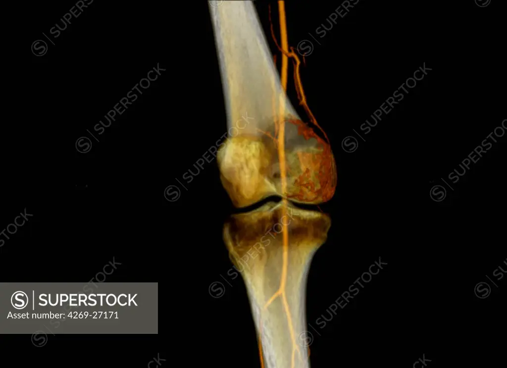 Osteoclastoma. 3D computed tomography (CT) scan of the knee showing the vascularization of a giant cell bone tumor (osteoclastoma) on the apophysis of the femur (red). The popliteal artery is in yellow.