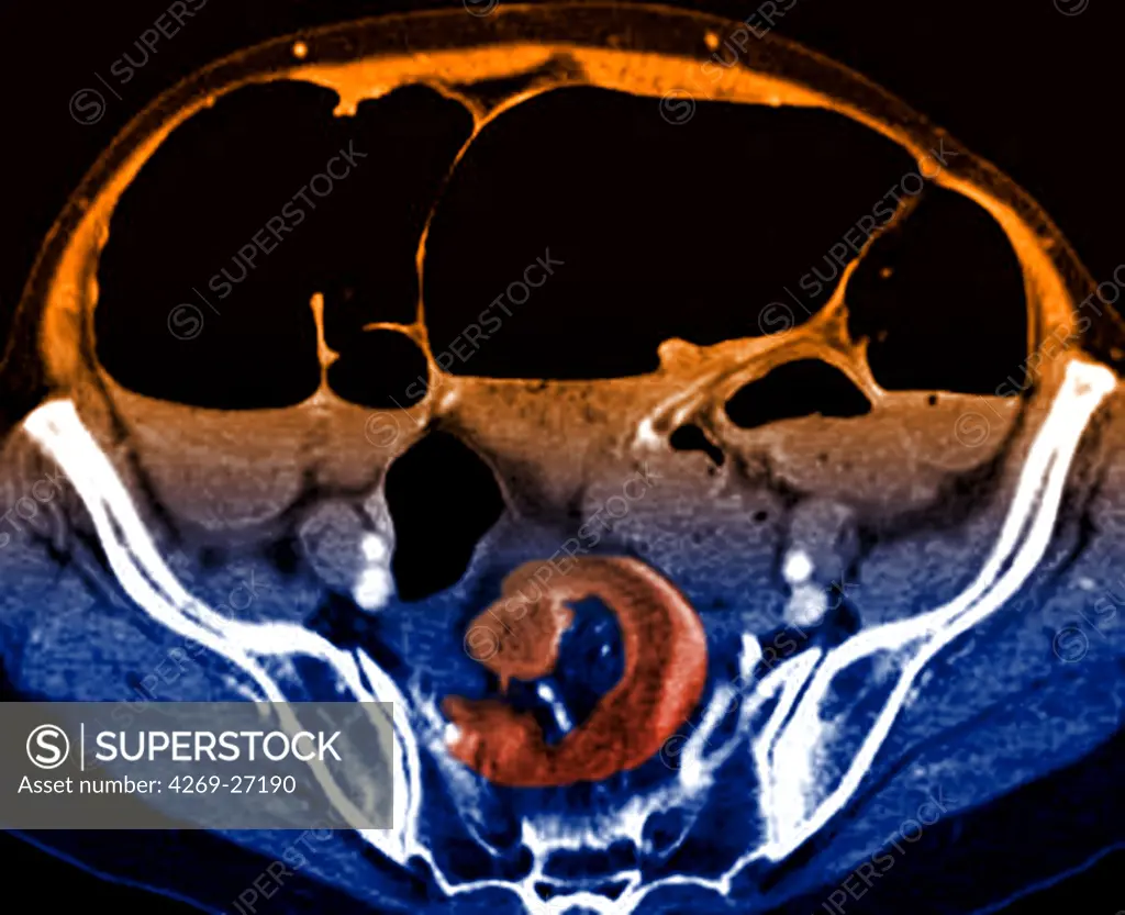 Intestinal obstruction. Color enhanced axial Computed Tomography (CT) scan of the abdomen showing a volvulus of the colon responsible for a bowel obstruction. It is evidenced by the winding of the colon loops around their axis (in red).