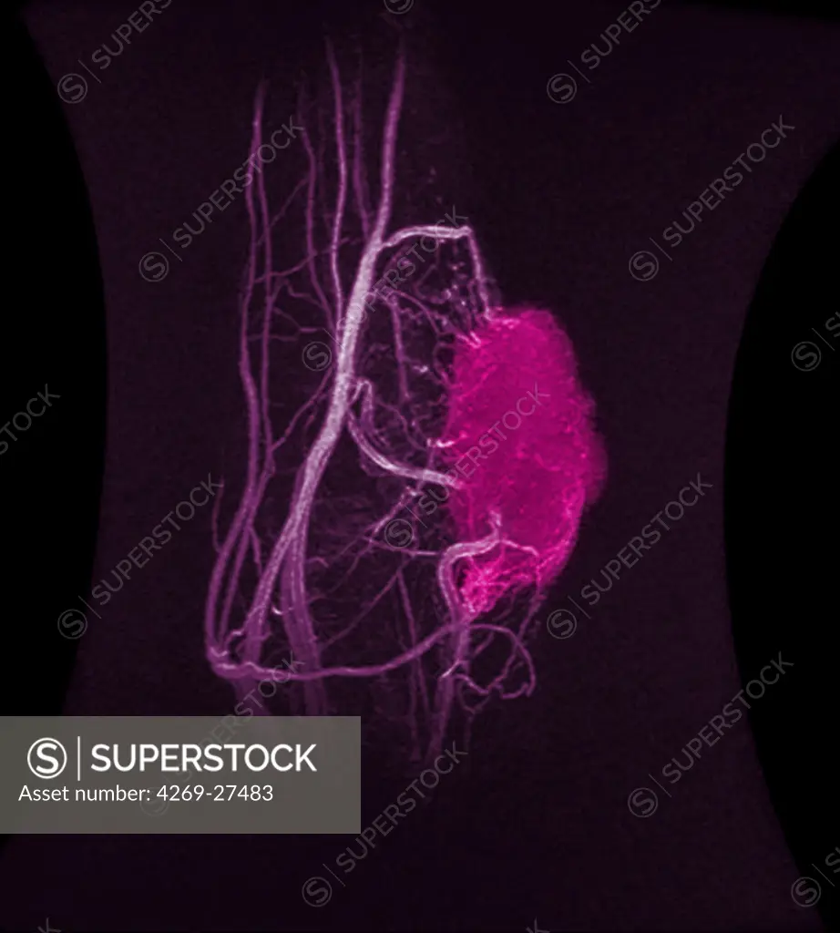 Synovial sarcoma. Sagittal side view MRI of the elbow showing the vascularization of a synovial sarcoma (or synovioma), a cancer of the synovial membrane lining the cartilage of the joint.