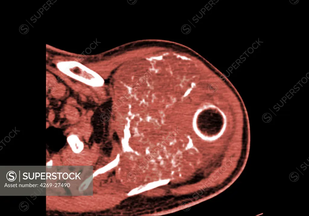 Shoulder chondrosarcoma. Colored enhanced Axial Computed Tomography (CT) scan of the shoulder showing a chondrosarcoma of the shoulder blade. The tumor is evidenced by the presence of a heterogenous lytic area with bone calcifications. The black round shape at right is the head of the humerus inserted into the shoulder blade.