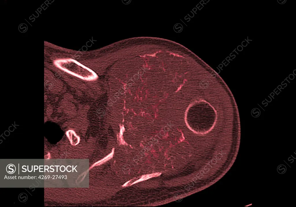 Shoulder chondrosarcoma. Colored enhanced Axial Computed Tomography (CT) scan of the shoulder showing a chondrosarcoma of the shoulder blade. The tumor is evidenced by the presence of a heterogenous lytic area with bone calcifications. The black round shape at right is the head of the humerus inserted into the shoulder blade.