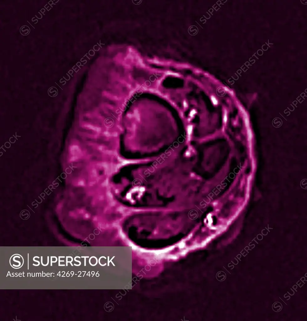 Epidermoid carcinoma. Colored enhanced Axial Computed Tomography (CT) scan of the calf showing a epidermoid carcinoma, a type of malignant skin  cancer. The tumor appears as the fleshy thickening at left. The section of the tibia is seen at top left, the section of the fibula, smaller, is below at right.