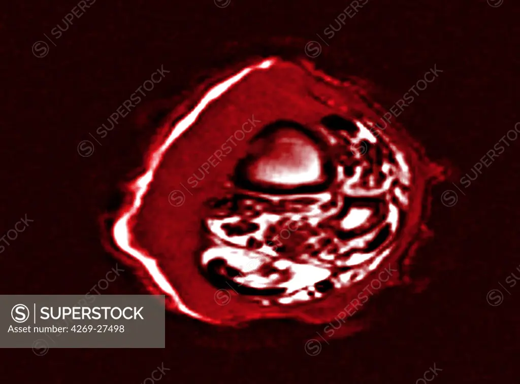 Epidermoid carcinoma. Colored enhanced Axial Computed Tomography (CT) scan of the calf showing a epidermoid carcinoma, a type of malignant skin  cancer. The tumor appears as the fleshy thickening at left. The section of the tibia is seen at top left, the section of the fibula, smaller, is below at right.