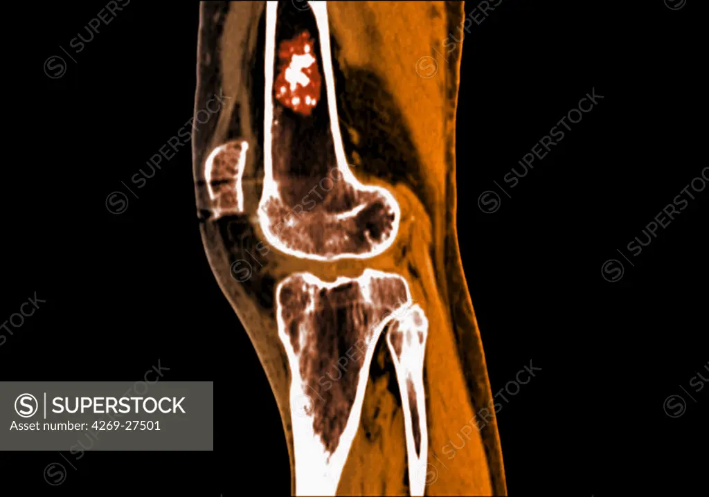 Chondroma. Sagittal MRI of the knee showing a chondroma of the femur (thigh bone). This benign bone tumor is formed by a calcified cartilage matrix giving the bone marrow its white spotted aspect.