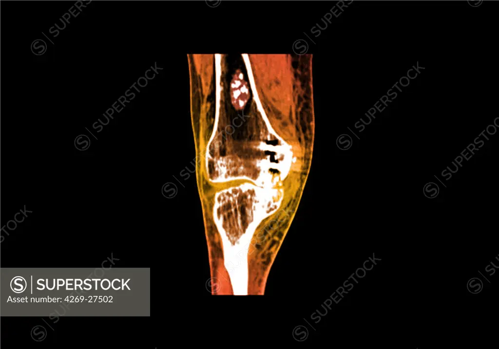 Chondroma. Sagittal frontal MRI of the knee showing a chondroma of the femur (thigh bone). This benign bone tumor is formed by a calcified cartilage matrix giving the bone marrow its white spotted aspect.