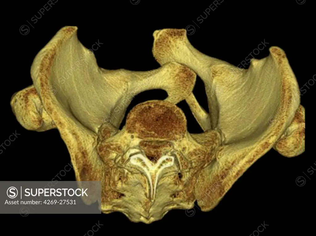 Pelvis luxation. 3D Computed Tomographic (CT) reconstruction scan of the pelvis seen from above showing a luxation of the symphysis pubica (cartilage joining the two pubis) further to a compaction.