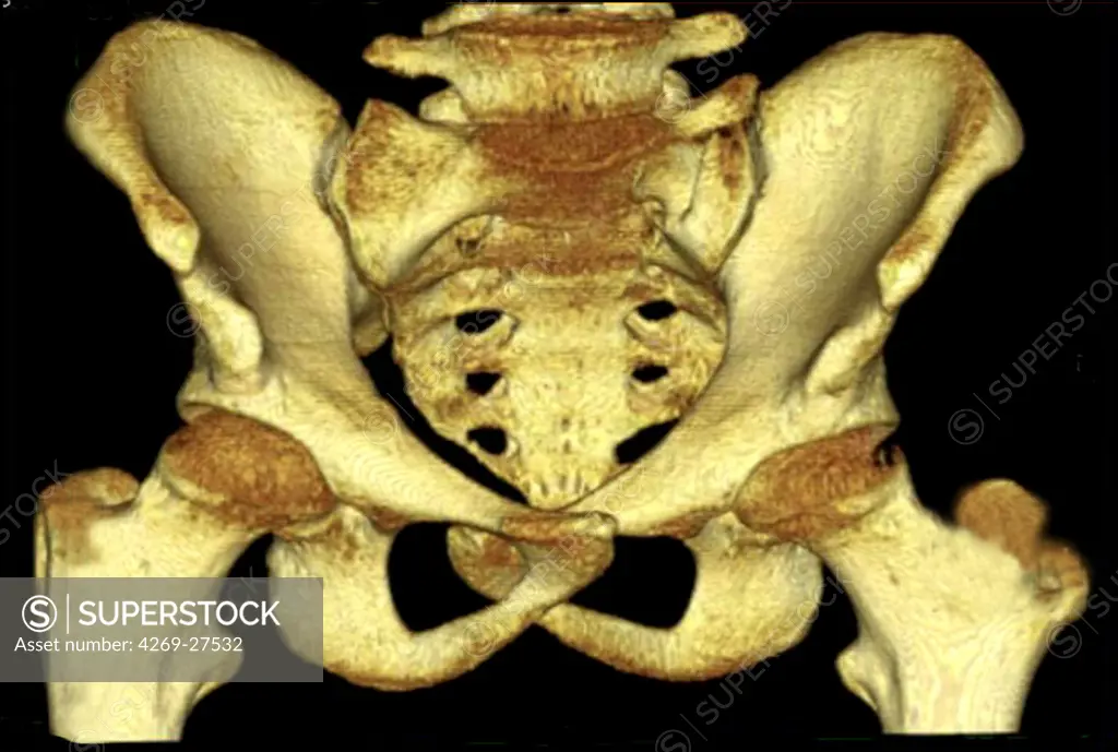 Pelvis luxation. 3D Computed Tomographic (CT) reconstruction scan of the pelvis showing a luxation of the symphysis pubica (cartilage joining the two pubis) further to a compaction.