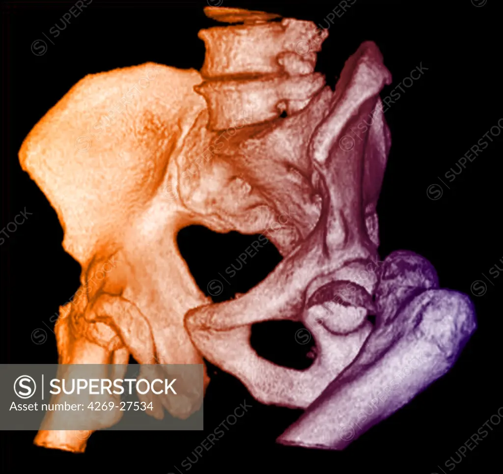 Dislocation of the hip. 3D Computed Tomographic (CT) reconstruction scan of the pelvis showing a posterior hip luxation. The head of the femur (bone of the thigh) has totally slipped out on its insertion point  in the pelvis bone.