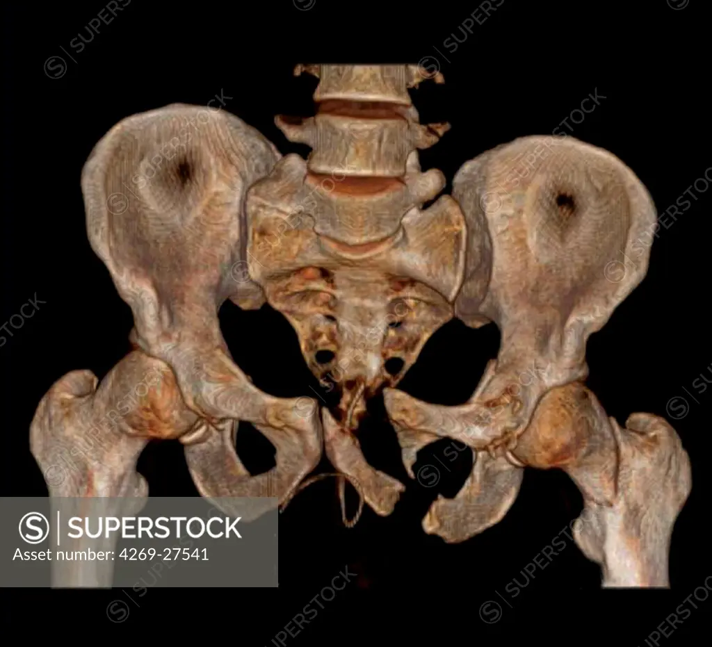 Fractured pelvis. 3D Computed Tomographic (CT) reconstruction scan of the pelvis showing a fracture of the left ischium (at right).