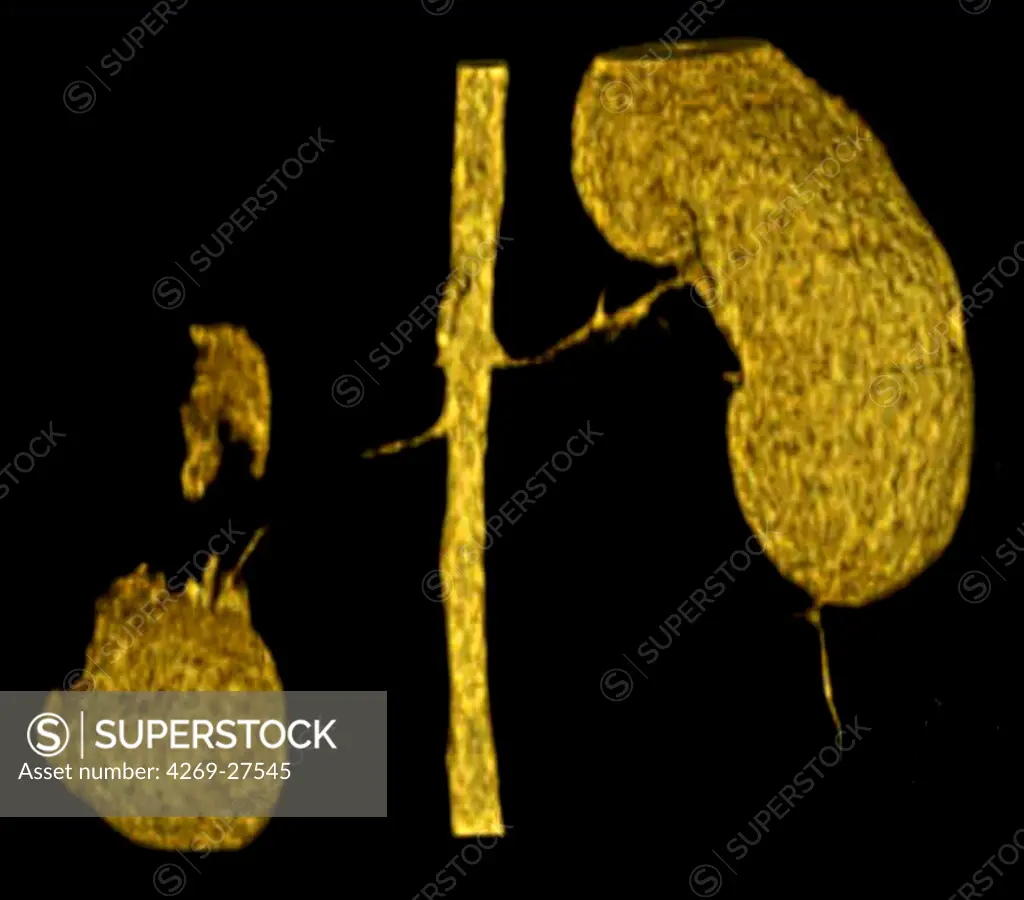 Renal infarct. 3D Computed Tomographic (CT) reconstruction scan of the kidneys showing a partial right renal infarct (at left on the photo). The infarcted (necrotic) areas of the kidney appears in black while the healthy parts are in yellow. Renal infarct is caused by deficient blood irrigation of the kidney.