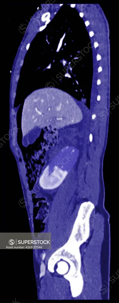 Renal infarct. Oblique sagittal Compted Tomography (CT) scan of the the trunc showing a partial right renal infarct. The infarcted (necrotic) areas of the kidney appears in dark blue (upper part of the kidney) while the healthy parts are in pale blue (lower part). Renal infarct is caused by deficient blood irrigation of the kidney.