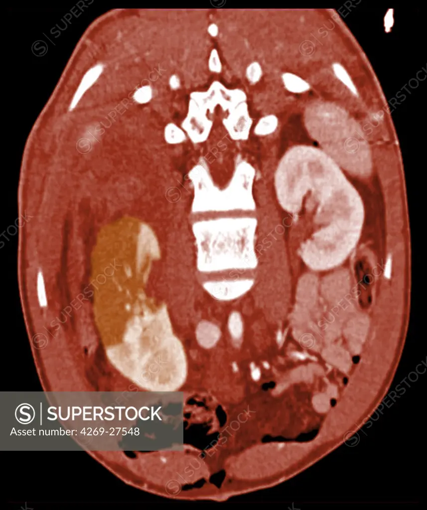 Renal infarct. Oblique axial Compted Tomography (CT) scan of the the trunc showing a partial right renal infarct. The infarcted (necrotic) areas of the kidney appears in orange (upper part of the kidney) while the healthy parts are in white (lower part). Renal infarct is caused by deficient blood irrigation of the kidney.