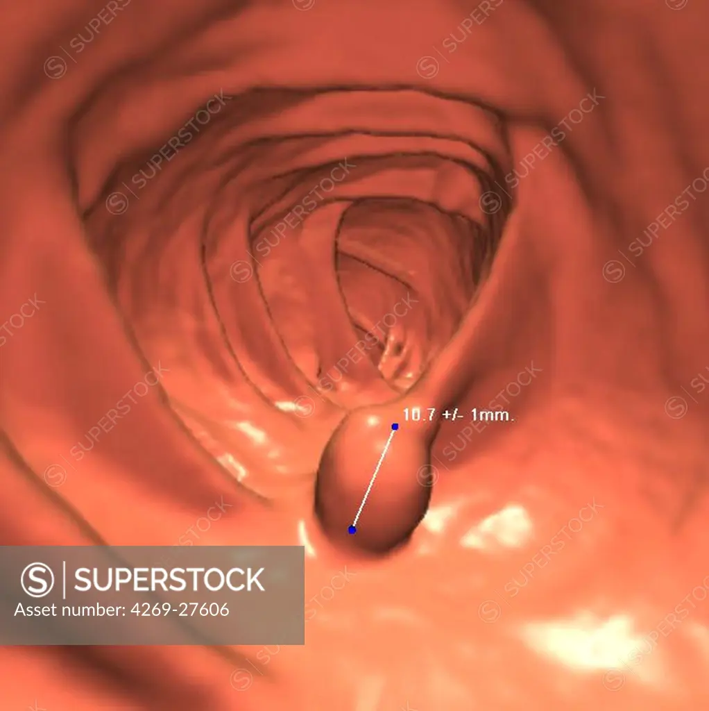 Virtual colonoscopy. A 3D computed tomography (CT) scan of the colon, showing a small polyp.