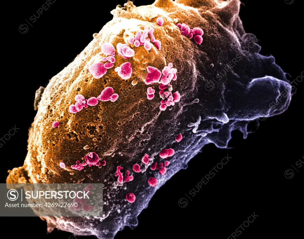 HIV. Scanning electron micrograph (SEM) of a lymphocyte with HIV cluster.