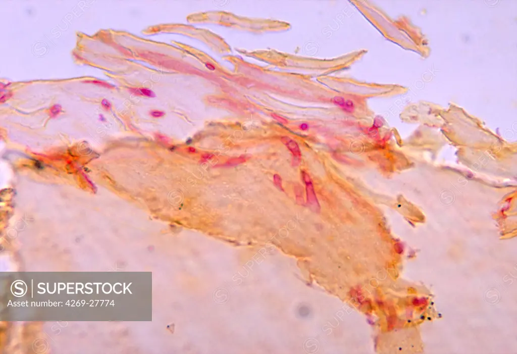 Onychomycosis. Photomicrograph of skin cells showing the skin desquamation in onychomycosis due to the fungus Fusarium sp.