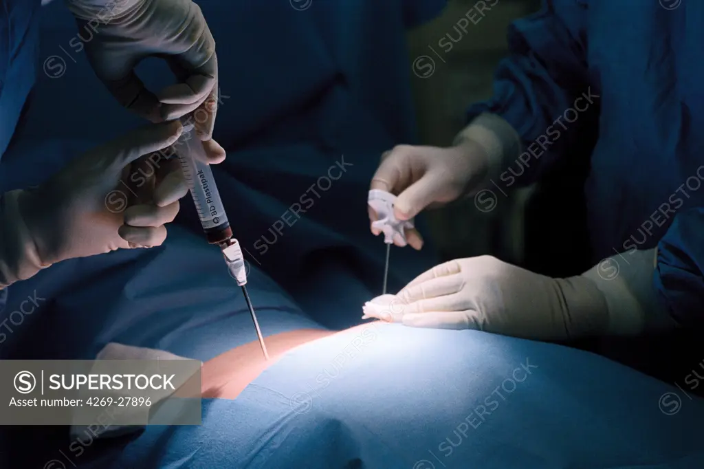 Bone marrow harvest. Surgeon performing bone marrow retrieval on patient placed in general anaesthesia. The bone marrow is collected from a pelvic bone with a trocar and a syringe. Saint-Louis hospital, Paris, France.