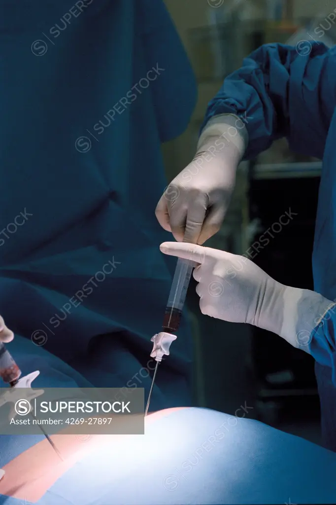 Bone marrow harvest. Surgeon performing bone marrow retrieval on patient placed in general anaesthesia. The bone marrow is collected from a pelvic bone with a trocar and a syringe. Saint-Louis hospital, Paris, France.