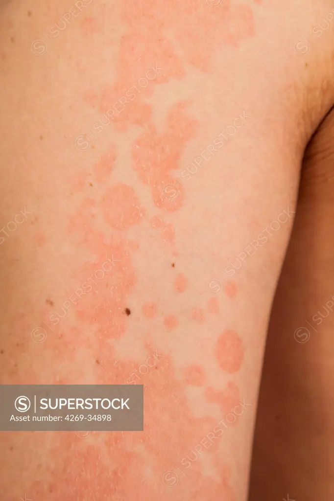 Pityriasis versicolor of the skin in an 18 year old female patient