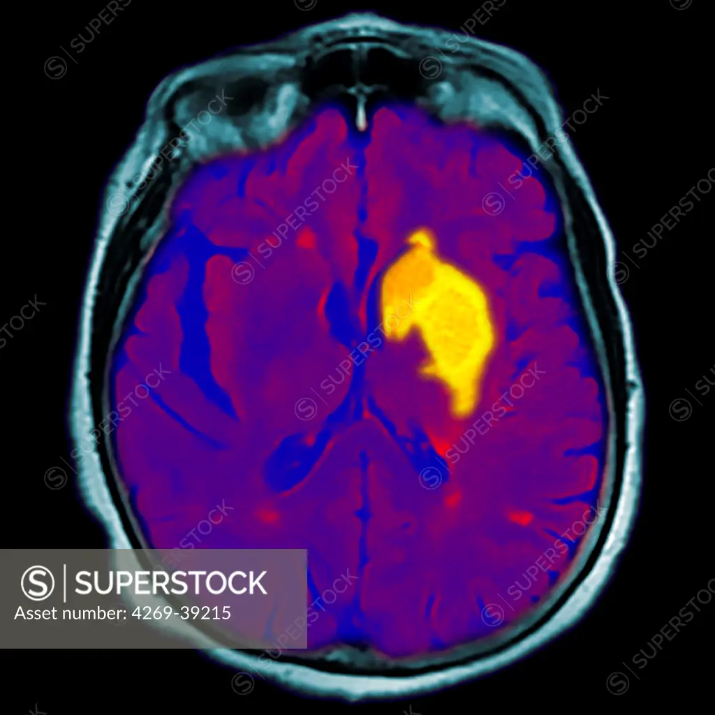 Coloured magnetic resonance imaging (MRI) scan and CT of an axial section through the brain of patient, showing the damage (yellow) caused 12 hours after a cerebral infarction.