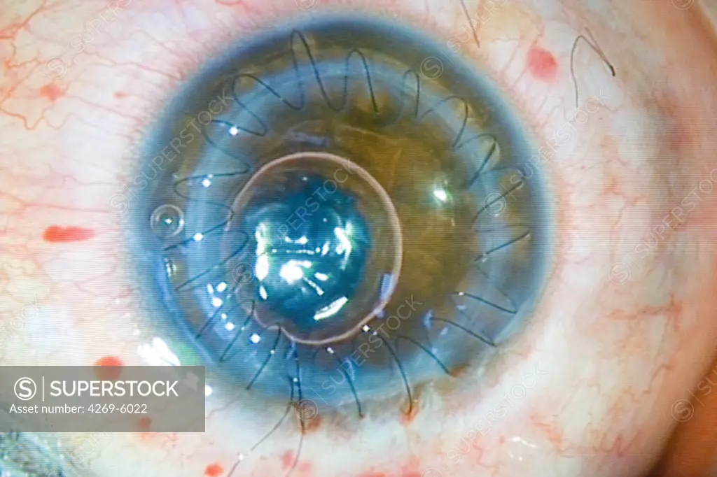 Corneal graft. Stitches are seen on the transplanted cornea.