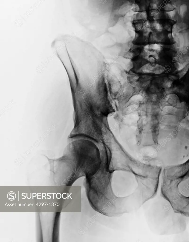 Normal hip x-ray of a 51 year old man