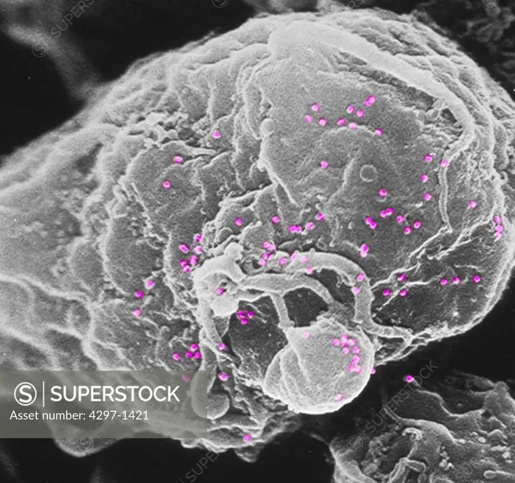 Scanning electron micrograph of human immunodeficiency virus (HIV), grown in cultured lymphocytes. Virions are seen as small spheres on the surface of the cells