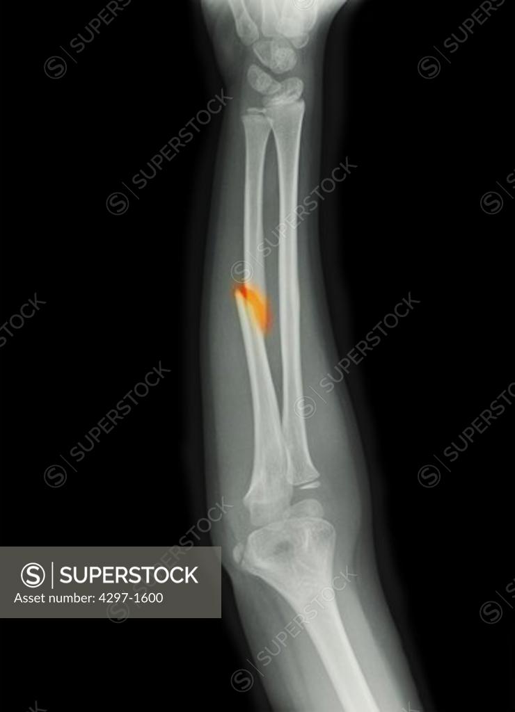 ulna fracture x ray