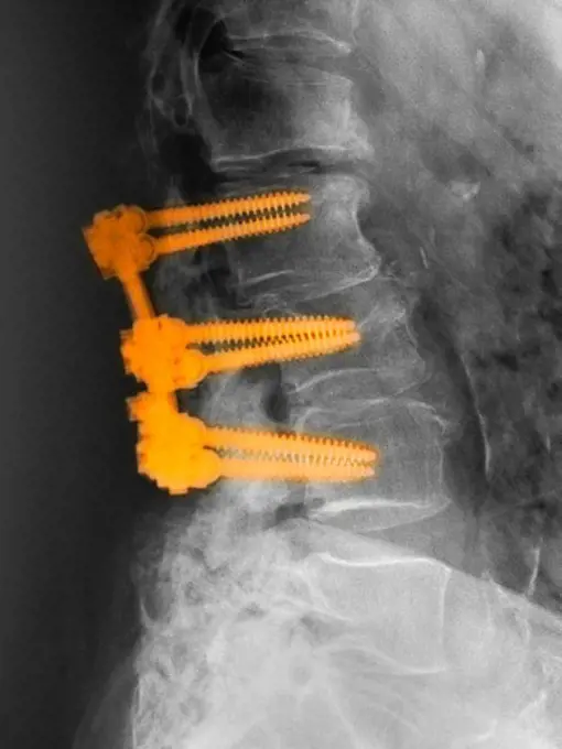 Lumbar spine of an 80 year old man with spinal fusion hardware