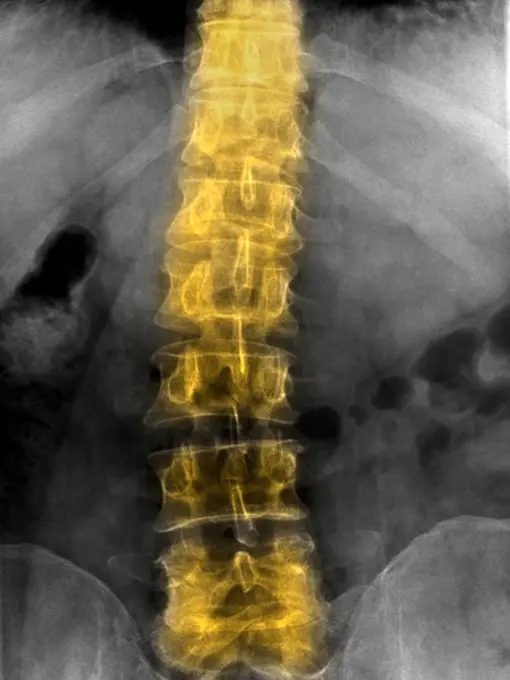 Lumbar spine x-ray of a 41 year old man showing minor degenerative changes