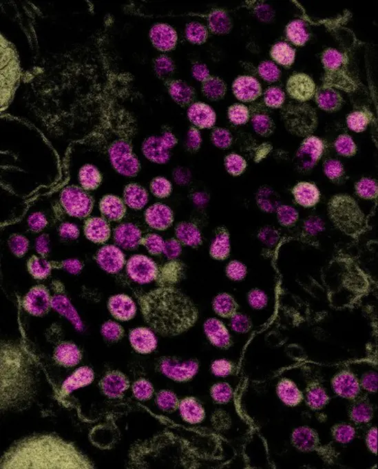 TEM image of coronavirus, the causative agent of SARS