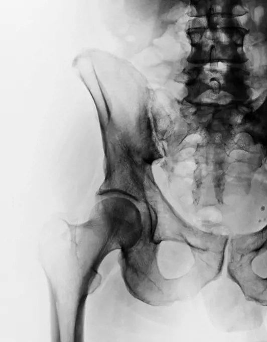 Normal hip x-ray of a 51 year old man