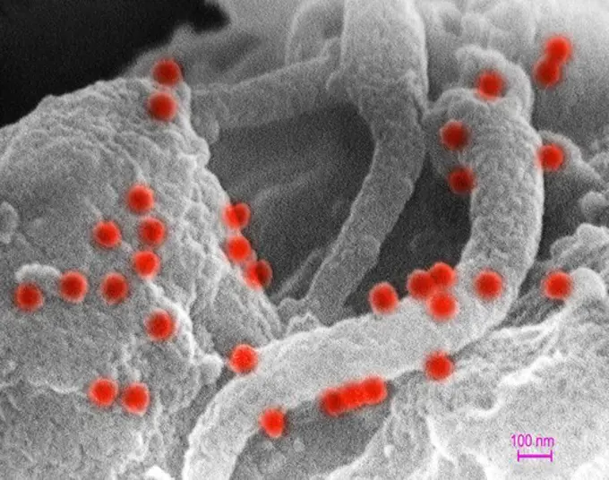 This scanning electron micrograph shows human immunodeficiency virus (HIV-1), (spherical in appearance) co-cultivated with human lymphocytes.