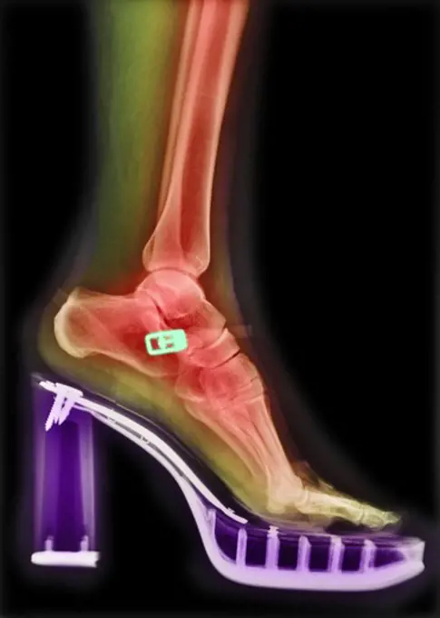 Colorized x-ray of a woman wearing high-heeled shoes