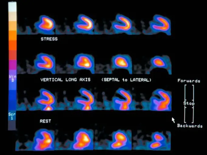 Myocardial Perfusion Imaging