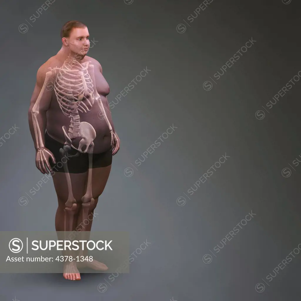 Human skeleton layered over image of man's body to reveal the severity of his overweight condition.