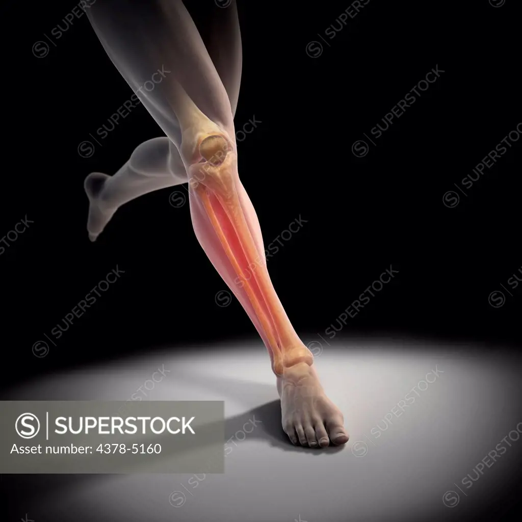 Medial Tibial Stress Syndrome