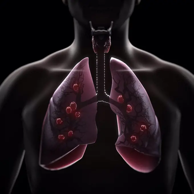 Multiple Lung Tumors