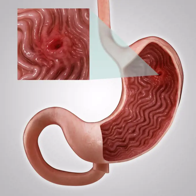 Gastric Ulcer