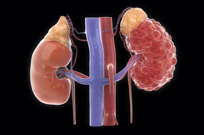 Polycystic Kidney