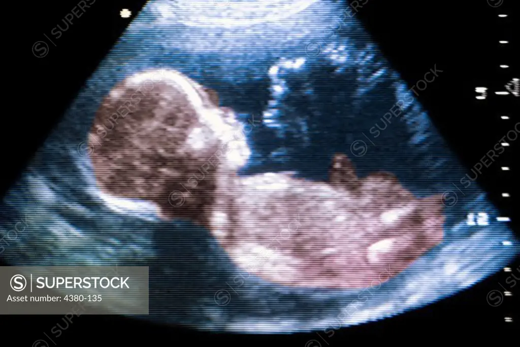 A Healthy Second Trimester Fetus as Seen Via Ultrasound