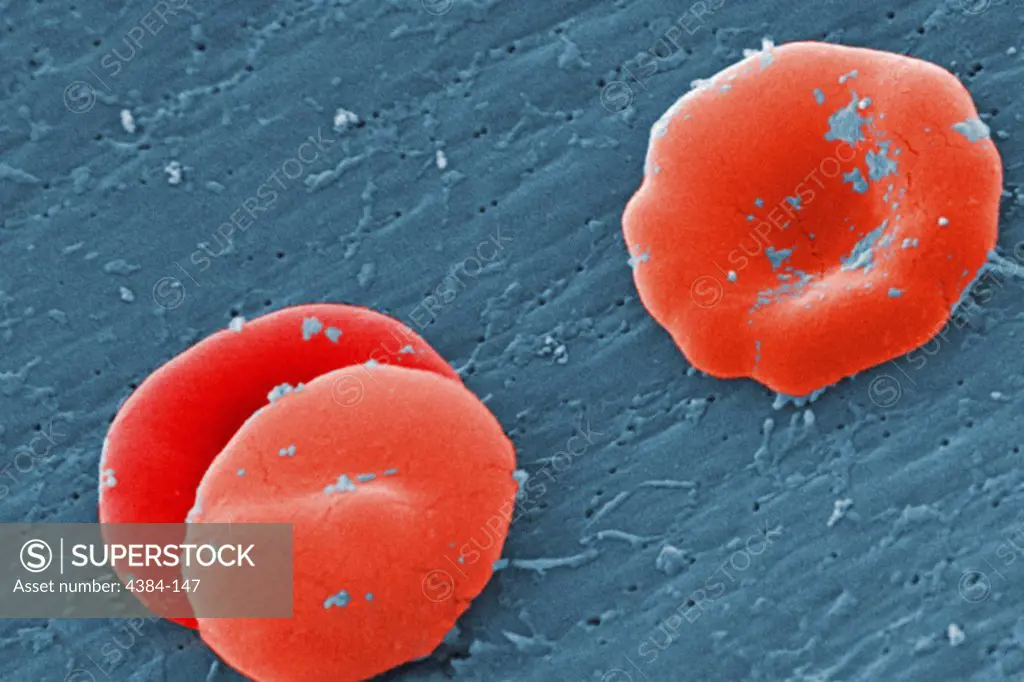 Under a high magnification of 8000X, this scanning electron micrograph (SEM) revealed some of the ultrastructural morphology displayed by red blood cells (RBCs) in a blood specimen of a 6 year old male patient with sickle cell anemia, which was accompanied by hereditary persistence of fetal hemoglobin (HPFH). In these individuals, the presence of the persistent fetal hemoglogin reduces the severity of the consequences of the sickle cell disease, thereby, reducing the degree of cellular deformity