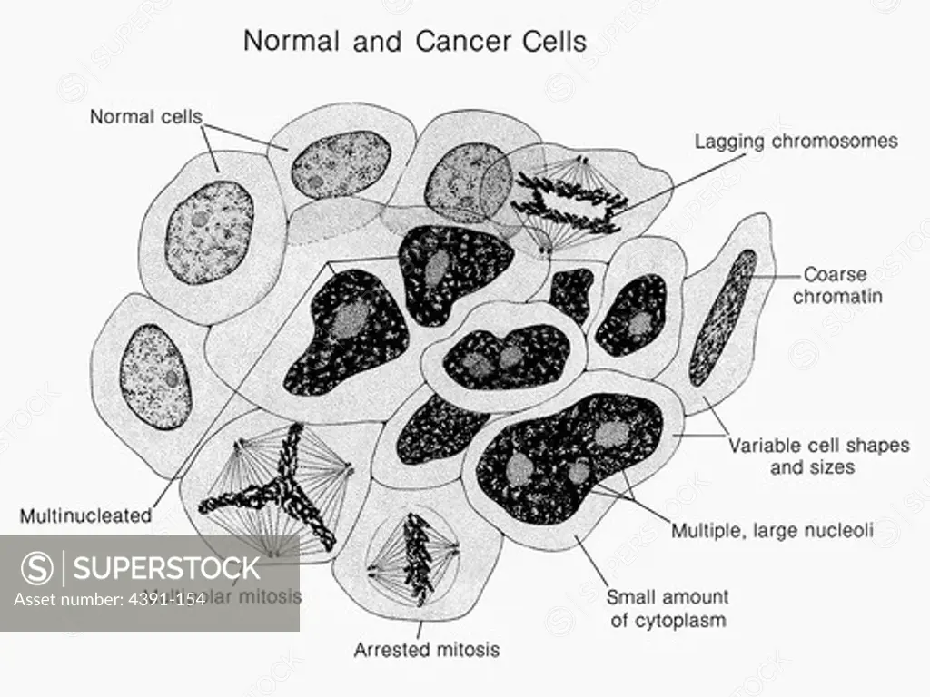 An artist's rendition of normal and cancer cells side-by-side. The normal and cancerous characteristics are identified. Illustration by Pat Kenny.