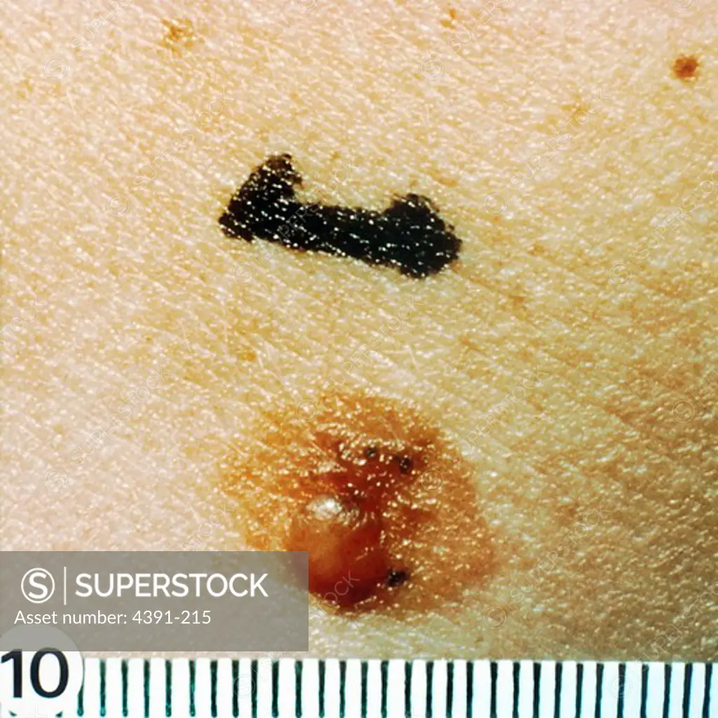 This mole has a characteristic 'fried egg' appearance. The eccentric papule is a perfectly ordinary nevus. The diagnostic histologic features are found in the macular portion of the mole, particularly at its shoulder - i.e. where the papule meets the macule.